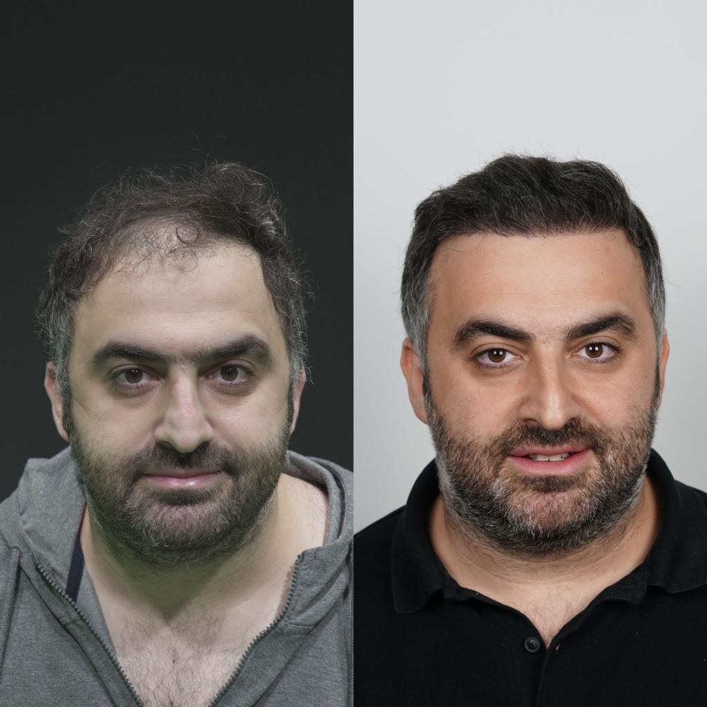 prima e dopo trapianto capelli 17